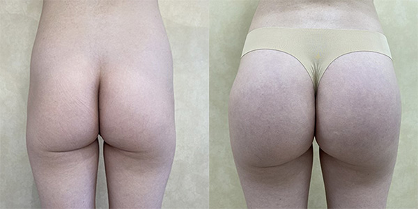 Before and after butt implants case back view female patient 1360