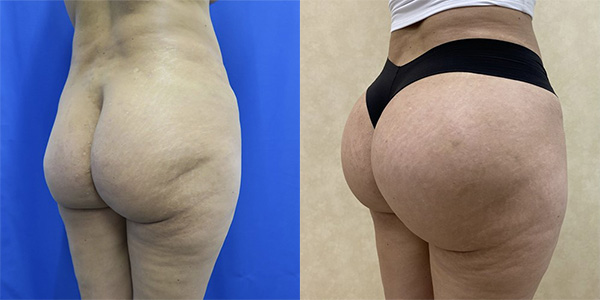 Before and after butt implants right angle female patient case 1363