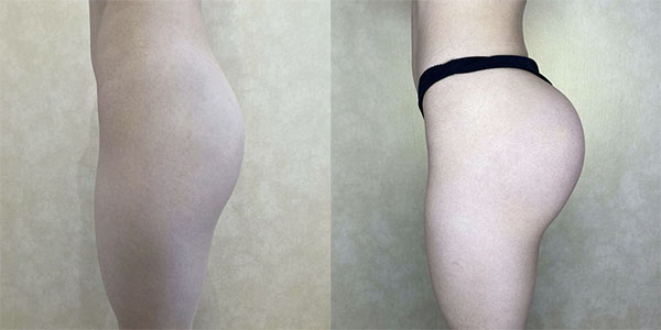 Before and after butt augmentation with implants left side view female patient case 1406