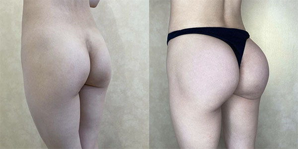 Before and after butt augmentation with implants left view female patient case 1406