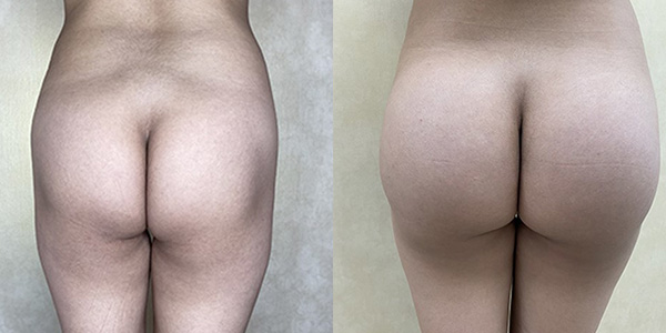 Before and after butt augmentation with implants back view female patient case 1422