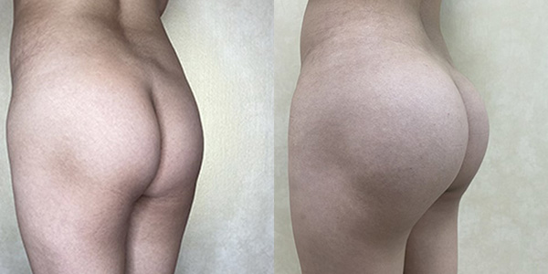 Before and after butt augmentation with implants left view female patient case 1422