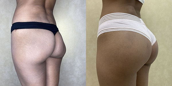 Before and after butt augmentation with implants left view female patient case 1426