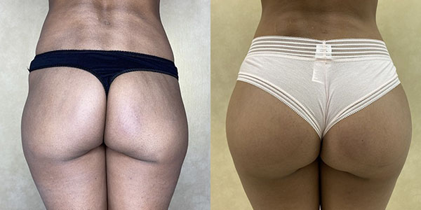 Before and after butt augmentation back view female patient case 1426