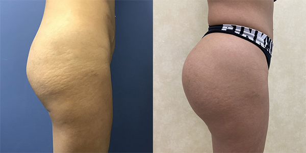 before and after buttock augmentation right side view female patient case 1493