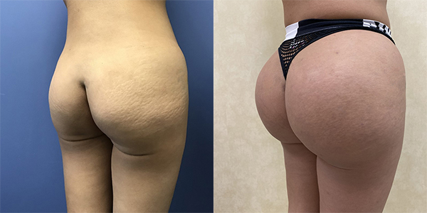 before and after buttock augmentation right view female patient case 1493