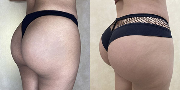 Before and after butt augmentation with implants right view female patient case 1663