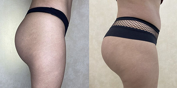 Before and after butt augmentation with implants right side view female patient case 1663