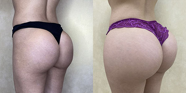 Buttock Augmentation with Implants Case 1790 - Stanton