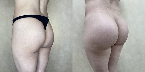 Before and after butt augmentation with implants left view female patient case 1847