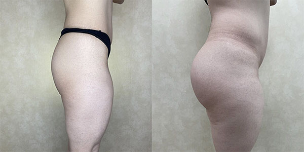 Before and after butt augmentation with implants right side view female patient case 1847