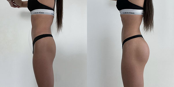 Before and after butt augmentation with implants left side view female patient case 1858