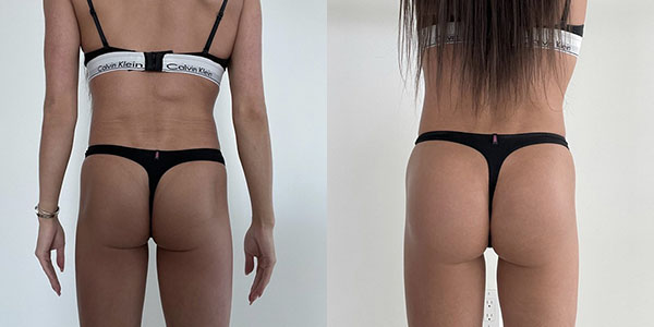 Before and after butt augmentation with implants back view female patient case 1858