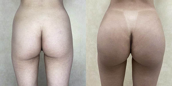 Before and after butt augmentation with implants back view female patient case 1873