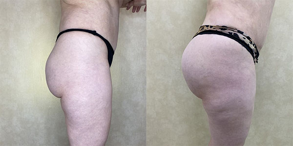 Before and after butt augmentation with implants right side view female patient case 1910