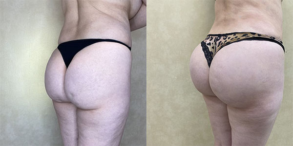 Before and after butt augmentation with implants right view female patient case 1910