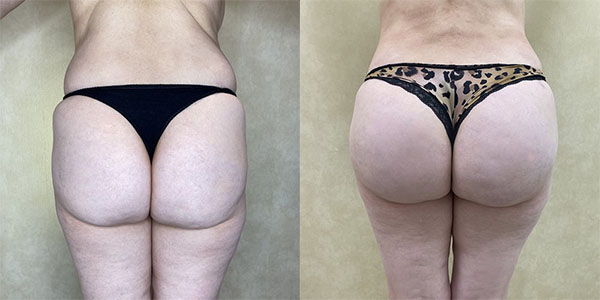 Before and after butt augmentation with implants back view female patient case 1910