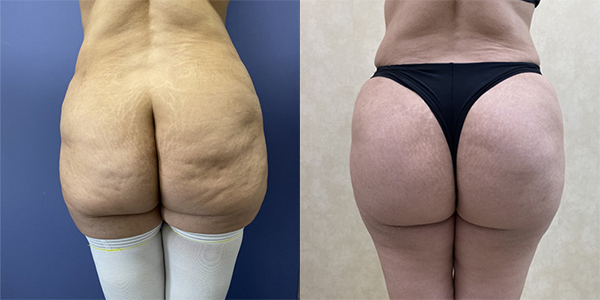 Before and after butt augmentation with implants back view female patient case 1955