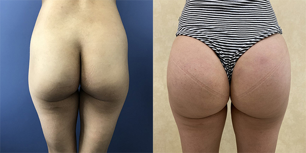 Before and after butt augmentation with implants back view female patient case 1963