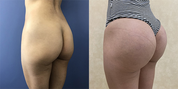 Before and after butt augmentation with implants left view female patient case 1963