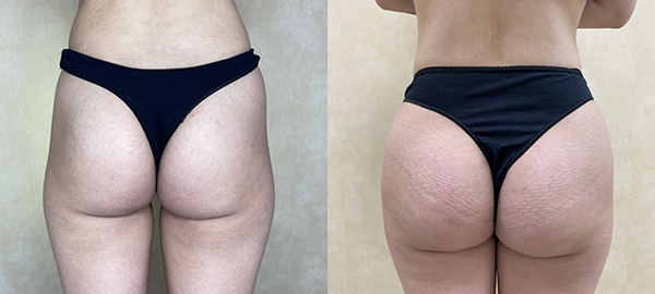 Before and after hip augmentation with implants back view female patient case 1939