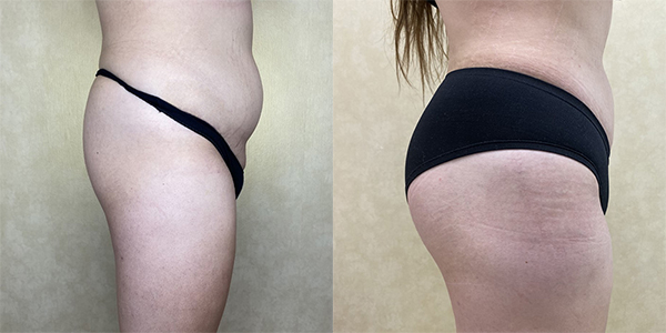 before and after buttock augmentation with implants right side view female patient case 2013