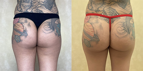 before and after buttock augmentation with implants back view female patient case 2016