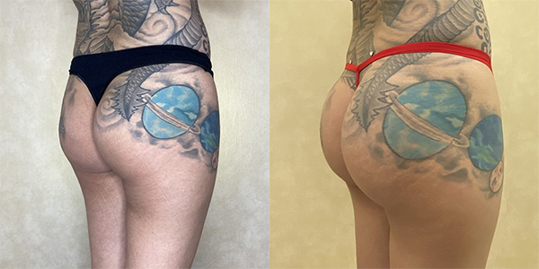 before and after buttock augmentation with implants right view female patient case 2016