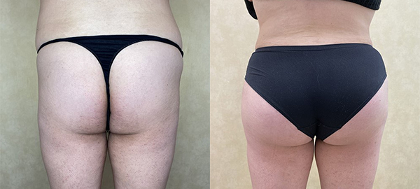 before and after hip augmentation with implants back view female patient case 2019