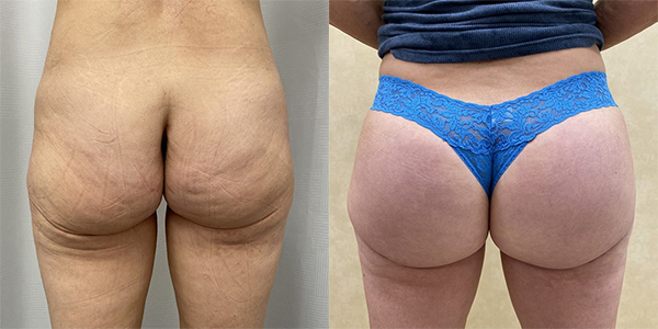 before and after lower buttock tuck back view female patient case 1988