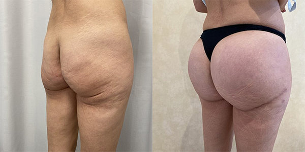 before and after lower buttock tuck right view female patient case 1988