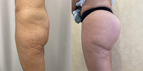 before and after lower buttock tuck left side view female patient case 1988