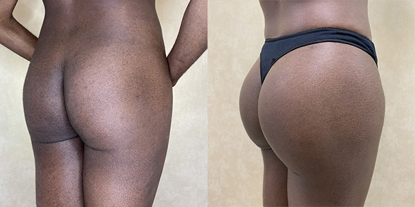 before and after buttock augmentation with implants right view female patient case 2053