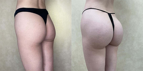 before and after buttock augmentation with implants left angle view female patient case 2178