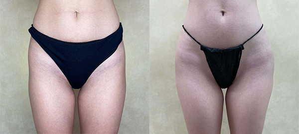 before and after hip augmentation with implants front view female patient case 2175