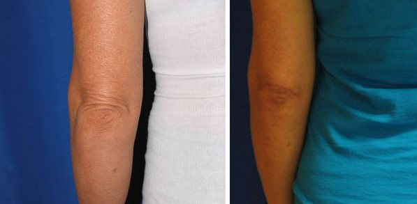 before and after celebrity elbow tuck left view female patient Los Angeles