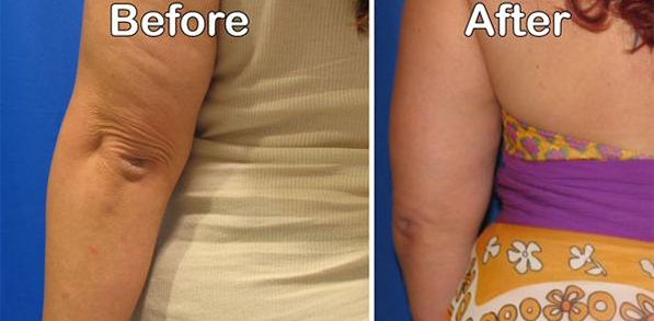 before and after celebrity elbow tuck left view female patient Los Angeles