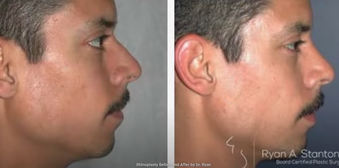 before and after rhinoplasty right view male patient Los Angeles