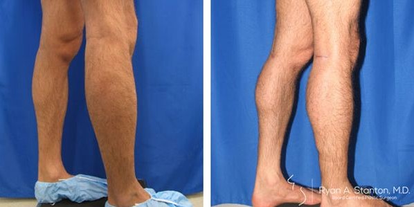 before and after calf augmentation left view male patient Los Angeles