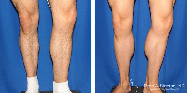 before and after calf augmentation left view male patient Los Angeles