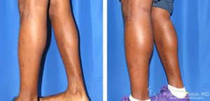 Calf Augmentation in Beverly Hills, CA | Dr. Ryan Stanton