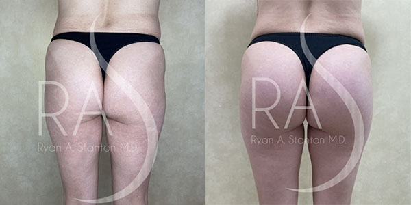 before and after back view buttock augmentation with implants female patient case 2927