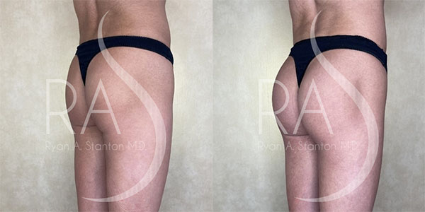 before and after right angle view buttock augmentation with implants female patient case 2936