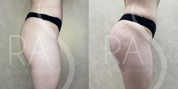 before and after right side view buttock augmentation with implants female patient case 2949