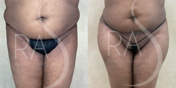 before and after front view buttock augmentation with implants female patient case 2961