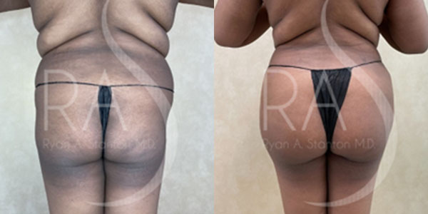 before and after back view buttock augmentation with implants female patient case 2961