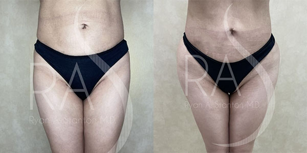 before and after front view butt augmentation with implants female patient case 2971