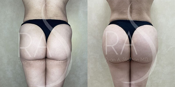 before and after back view butt augmentation with implants female patient case 2971