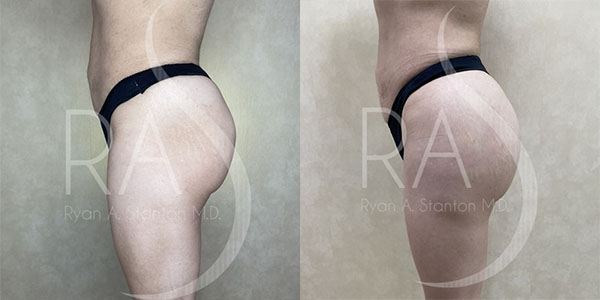 before and after left side view butt augmentation with implants female patient case 2971