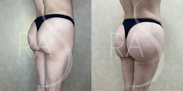 before and after right angle view butt augmentation with implants female patient case 2971